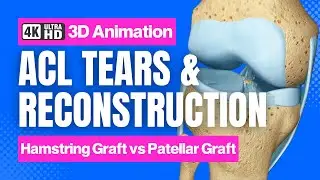 ACL Tear + ACL Reconstruction // See How It Works // 3D Animation