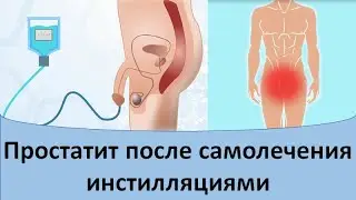 Простатит после самолечения инстилляциями