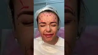 БОТОКС на всё лицо?
