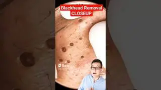 ULTIMATE BLACKHEAD REMOVAL - So Many Blackheads #shorts