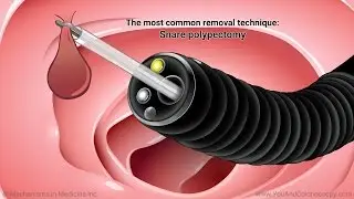 What happens during and after a colonoscopy?