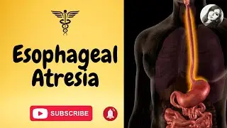 Esophageal atresia & tracheoesophageal fistula causes, types, symptoms, diagnosis & treatment