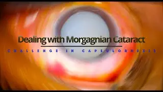 MIIQ 66: Cataract Surgical Step | Capsulorhexis 3: Morgagnian Cataract | DR. MD IFTEKHER IQBAL RAJU