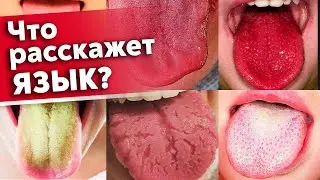 Язык предупредит вас о болезнях! | Как диагностировать состояние организма по языку?