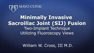 Minimally Invasive Sacroiliac Joint (SIJ) Fusion Two-implant technique utilizing Fluoroscopy views