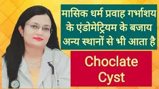 Choclate Cyst#  मासिक धर्म प्रवाह गर्भाशय के एंडोमेट्रियम के बजाय अन्य स्थानों से भी आता है