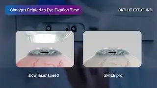 Impact of Laser Speed on the Cornea with Smile Pro VisuMax 800 / Bright Eye Clinic Gangnam