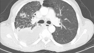 Flummoxing Paradox of Tuberculous Pleural Effusion