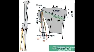 High Tibial Osteotomy for Medial Compartment OA Knee