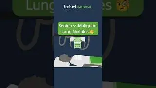 Benign vs Malignant Lung Nodules 🧐 #USMLE #MedicalEducation #Radiology