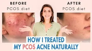 How I Healed My Cystic Acne NATURALLY (PCOS & Hormonal Acne)