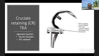 Implant design in Total Knee Replacement