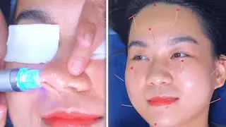 ASMR | Cosmetic Acupuncture | Pore Cleaning | 피부관리