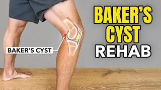 Baker's Cyst Treatment (Rehab Exercises)