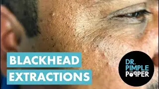 A Blackhead Extractor & Tweezer Dance