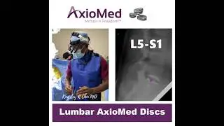 DR. KINGSLEY CHIN EXCITED WITH AXIOMED VISCOELASTIC DISC REPLACEMENT FOR LUMBAR SPINE SURGERY