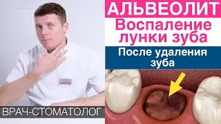 Альвеолит - воспаление лунки зуба после удаления зуба. Причины, симптомы, лечение альвеолита