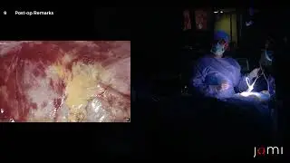 How to : Laparoscopic Totally Extraperitoneal (TEP) Left Indirect Inguinal Hernia Repair with Mesh