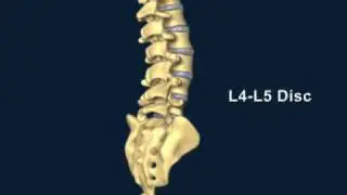 Herniated Disc