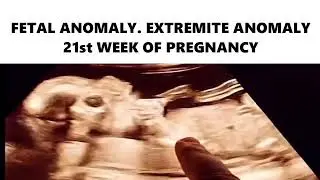 FETAL ANOMALY. EXTREMITE ANOMALY 21st WEEK OF PREGNANCY #ultrasound #pregnancyscan #pregnancytest