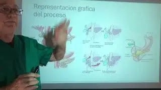 Páncreas Anular. Estenosis Duodenal. Signo de la doble burbuja. Ictericia obstructiva