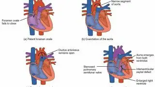 Difference Between Cyanotic and Acyanotic Congenital Heart Defects