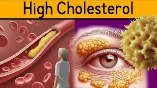 5 Signs of High Cholesterol - The Silent Dangers of High Cholesterol