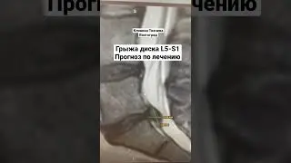 Грыжа диска L5-S1. Прогноз по лечению.