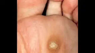 Apple Cider Vinegar Wart Treatment @ HOME!