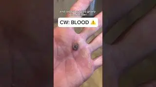 How I take care of blood blisters 😬 CW: Blood for educational purposes ⚠️ 