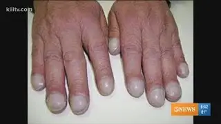 What your fingernails say about your health
