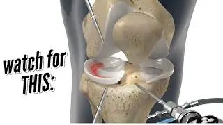 Meniscus Repair vs Meniscectomy