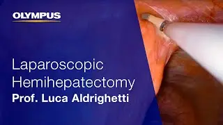 Laparoscopic Hemihepatectomy | THUNDERBEAT | Prof. Luca Aldrighetti