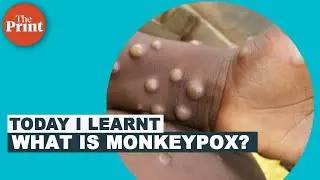 What is Monkeypox, its symptoms & causes