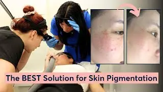 How Can You Achieve Perfect Skin With This Laser?