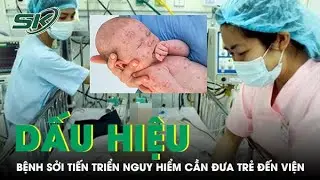 Dấu hiệu bệnh sởi tiến triển nguy hiểm cha mẹ cần đưa trẻ đến viện ngay  | SKĐS
