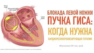 Блокада левой ножки пучка Гиса: когда нужна кардиоресинхронизирующая терапия