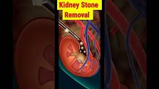 Kidney Stone Removal 3D 