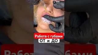 То,что не расскажут другие! Весь процесс увеличения губ 