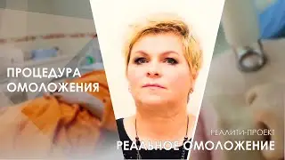 Самая ЭФФЕКТИВНАЯ процедура по ОМОЛОЖЕНИЮ кожи лица / Лазерное омоложение RecoSMA