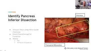 SAGES HPB Facebook Group All Things Distal Pancreatectomy Livestream