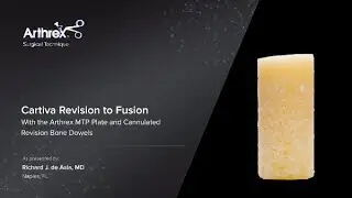 Cartiva Revision to Fusion With the Arthrex MTP Plate and Cannulated Revision Bone Dowels