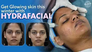 Hydrafacial treatment to cleanse, extract, and hydrate the skin.