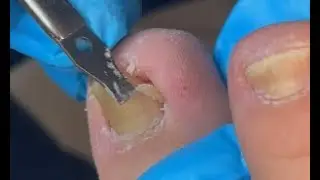 Super thick super hard nail treatment