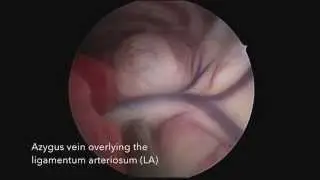 PRAA in a 7 week old puppy ( Minimally Invasive Correction)