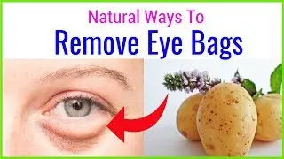 How to remove eye bags with natural remedies