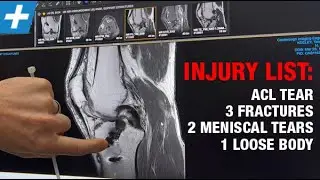 ACL Tear and Multiple Fractures from Skiing Injury (NO KNEE SURGERY!)