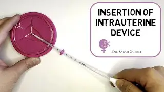 Insertion of Intrauterine Device