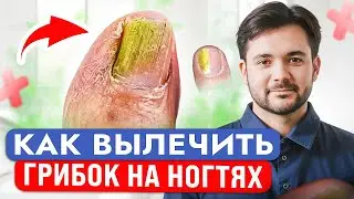 Лечение ГРИБКА НОГТЕЙ в Домашних условиях!