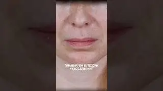 Комплексная операция по омоложению губ 